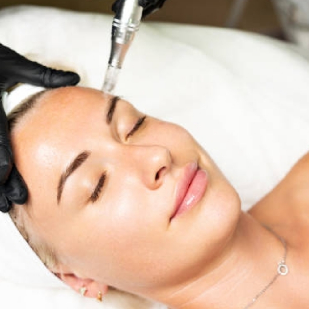 Micro Needling Facial at Beautyfull Esthetics in Riverside, CA