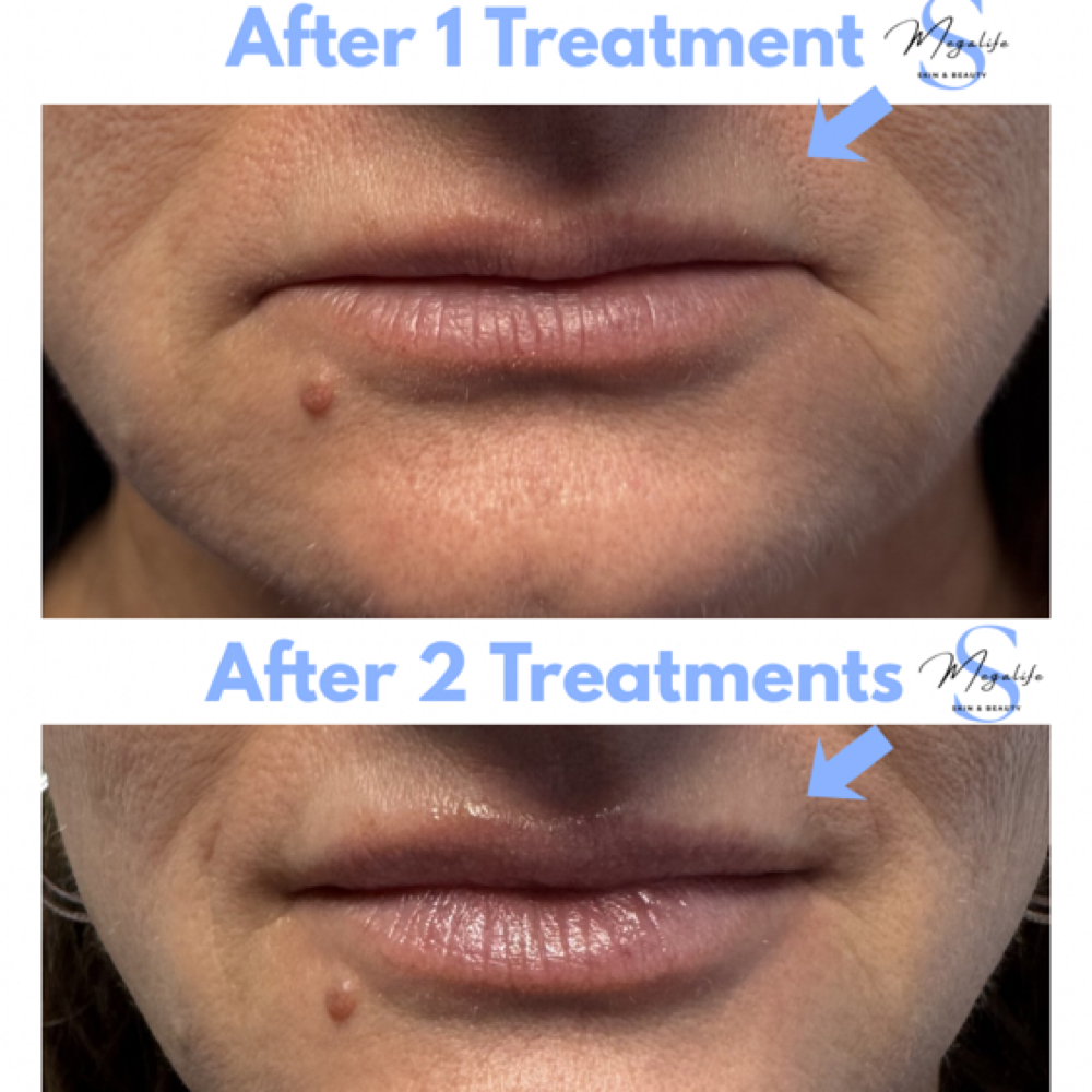 Exion Demo at Megalife Skin & Beauty in Tempe, AZ