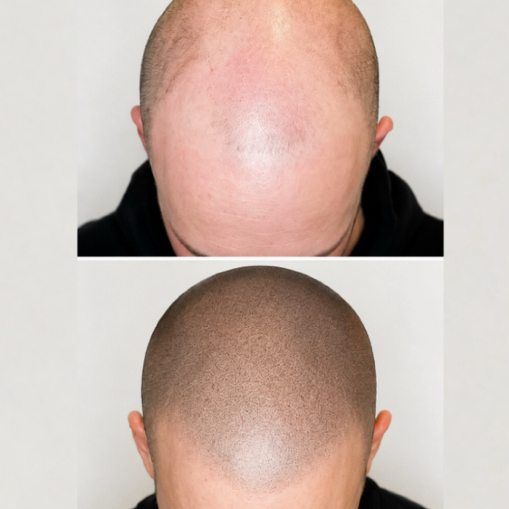 8-12 wk Scalp MicroPgmnt TouchUp at Justbeyou.tiful Beauty Bar in Lonetree, CO