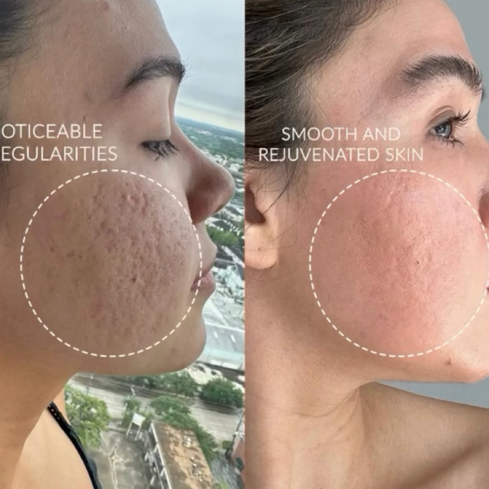 5 Glacial Glide Add-Ons – Save $150 at SKIN CLINIC in Laguna Hills, CA