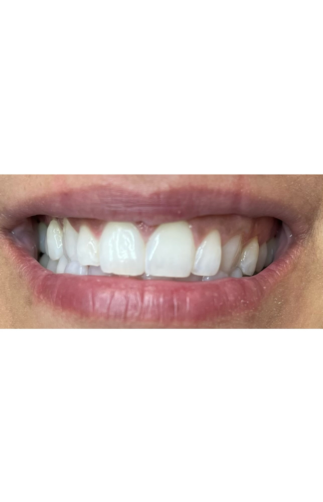 Teeth Whitening- Double