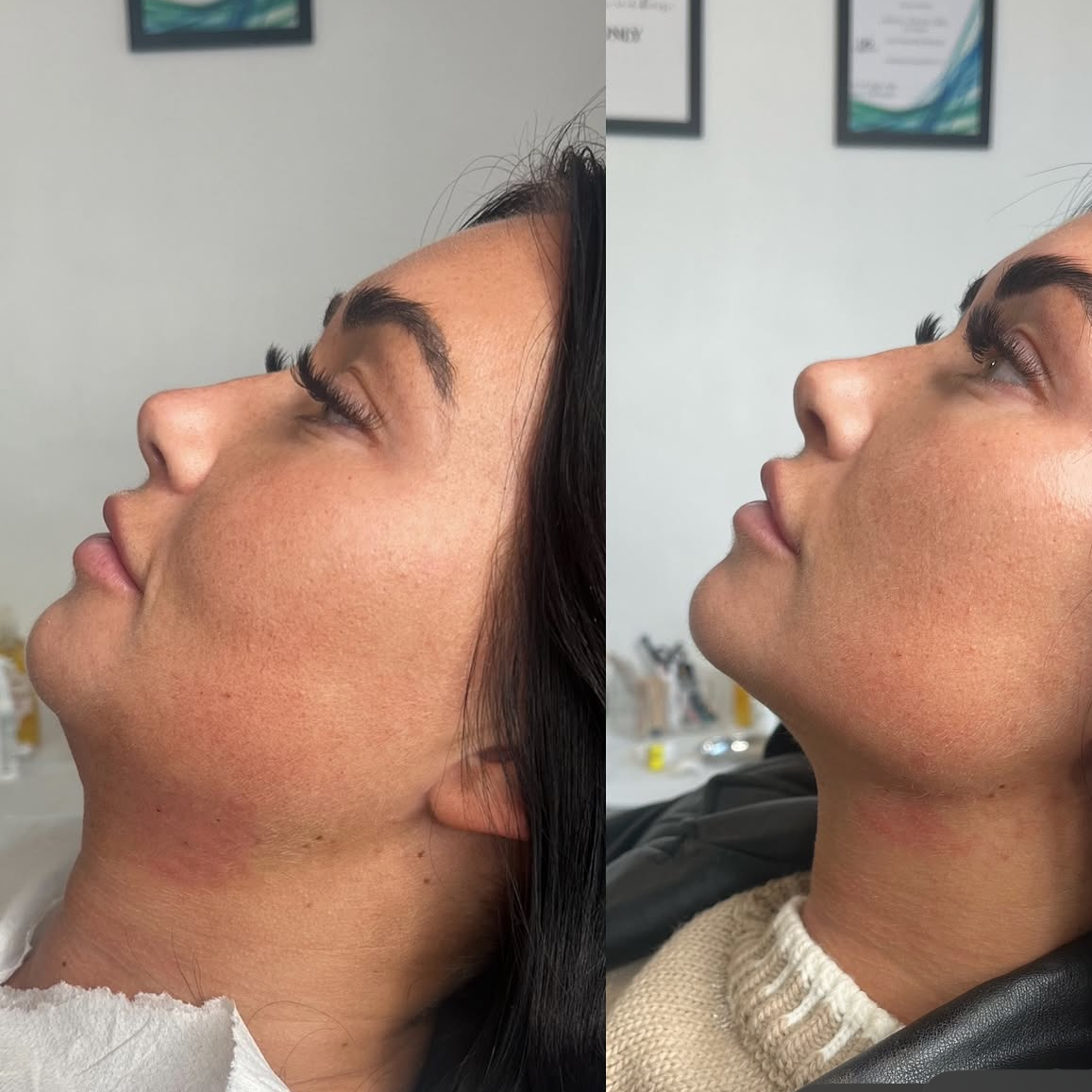 Fat Dissolver: (PCDC Face) at Akki Aesthetics in Williston Park, NY