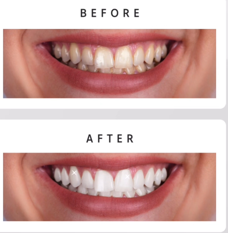 6 Sessions Teeth Whitening