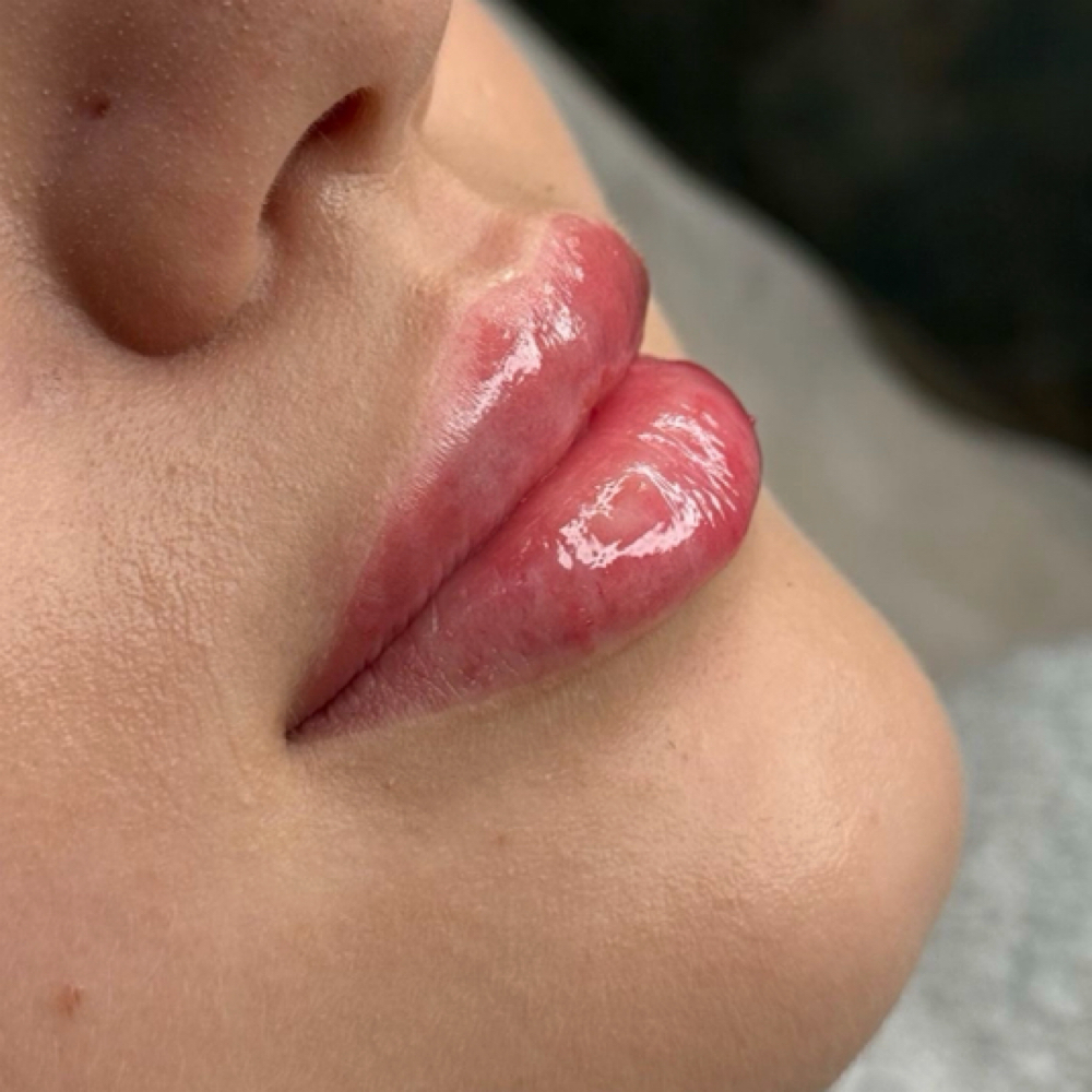 Filler de Labios at Bella Vivi in Orlando, FL