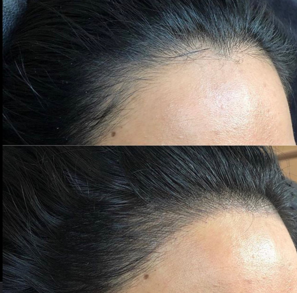 Scalp Microblading