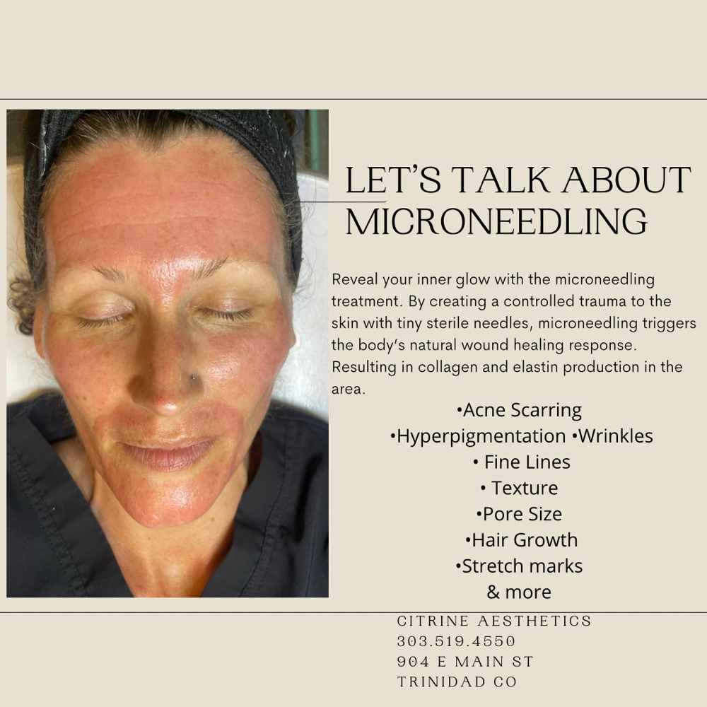 Microneedling With HA Infusion