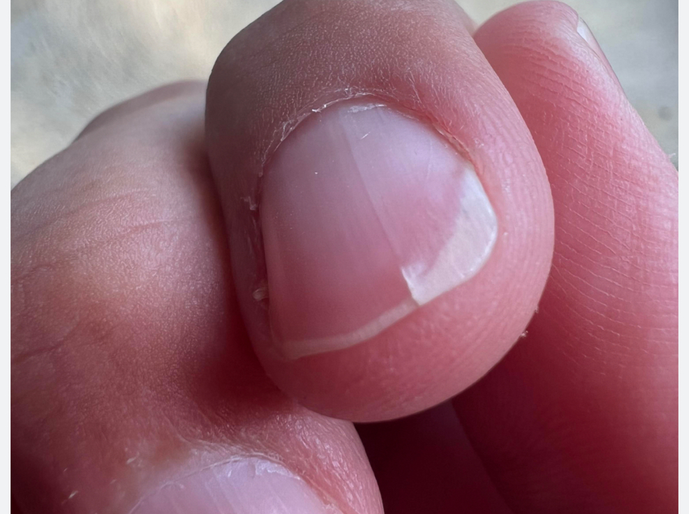 Nail Repair