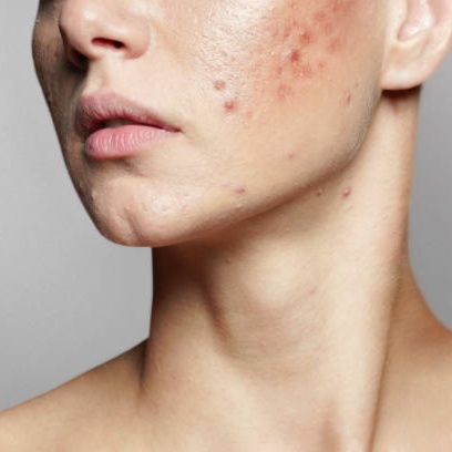 Acne Reset Facial at Haus of Glam by Karina J in Haverhill, FL