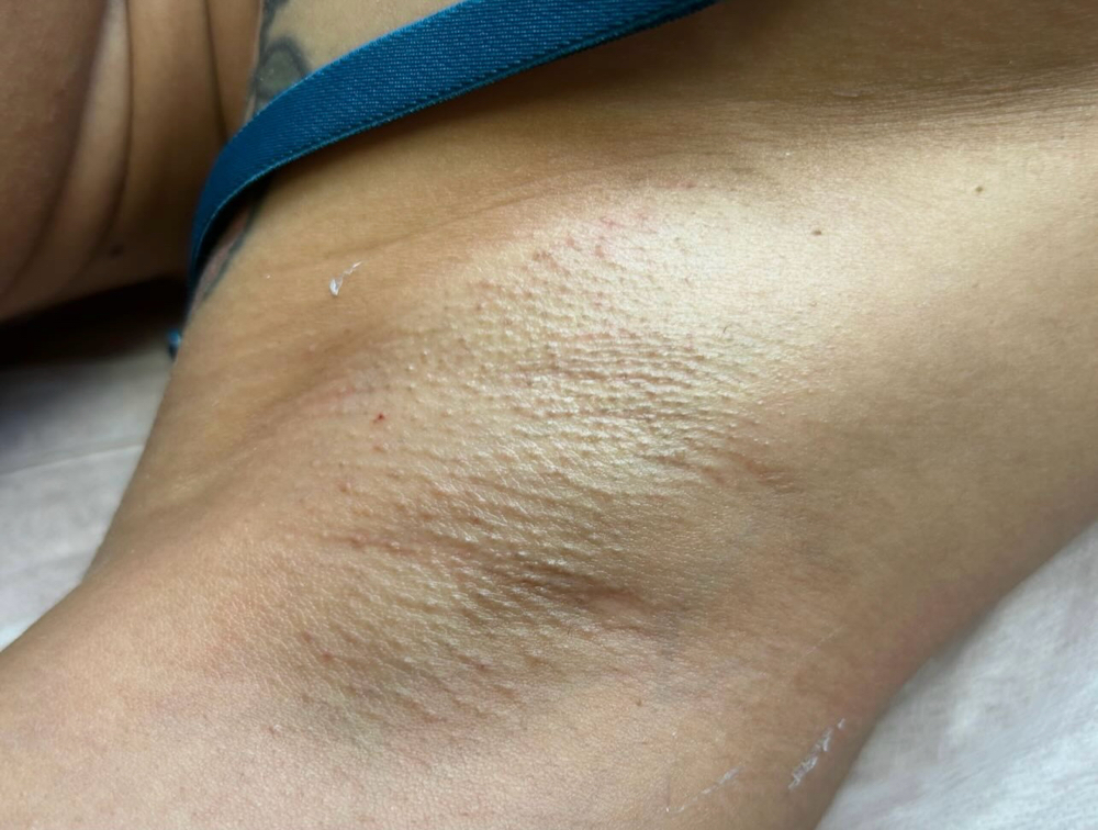 Underarms at Skinhours in Kenilworth, NJ