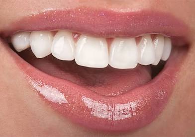 Radiant Boost Teeth Whitening
