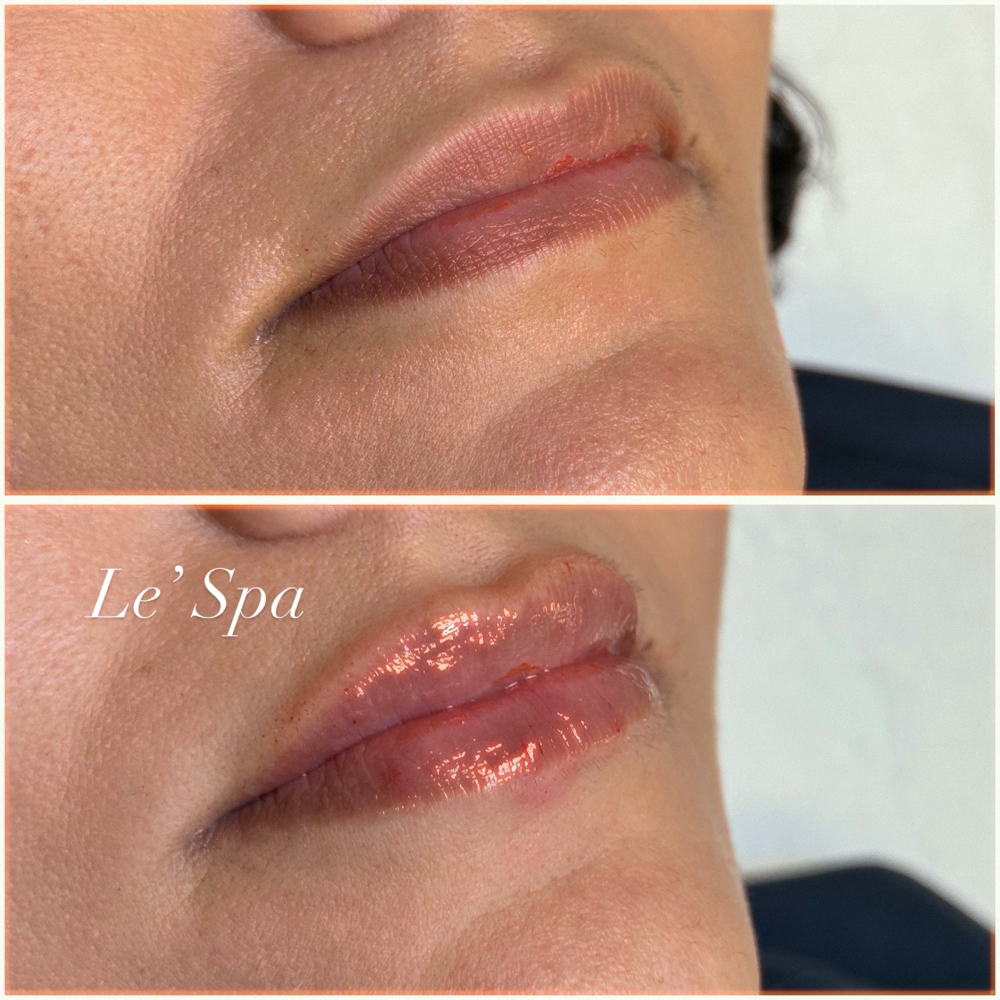 Lip Fillers at Le' Spa in McAllen, TX