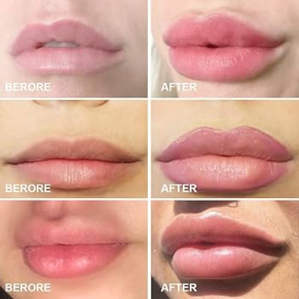 💋 Non-Invasive Lip Plumping, Rejuv at The Teacup Body Sculpt & Glow in Hillside, IL