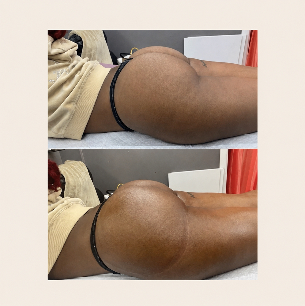 Butt Lift + Cellulite Therapy at BODIEDBYNICKEI LLC in The Bronx, NY