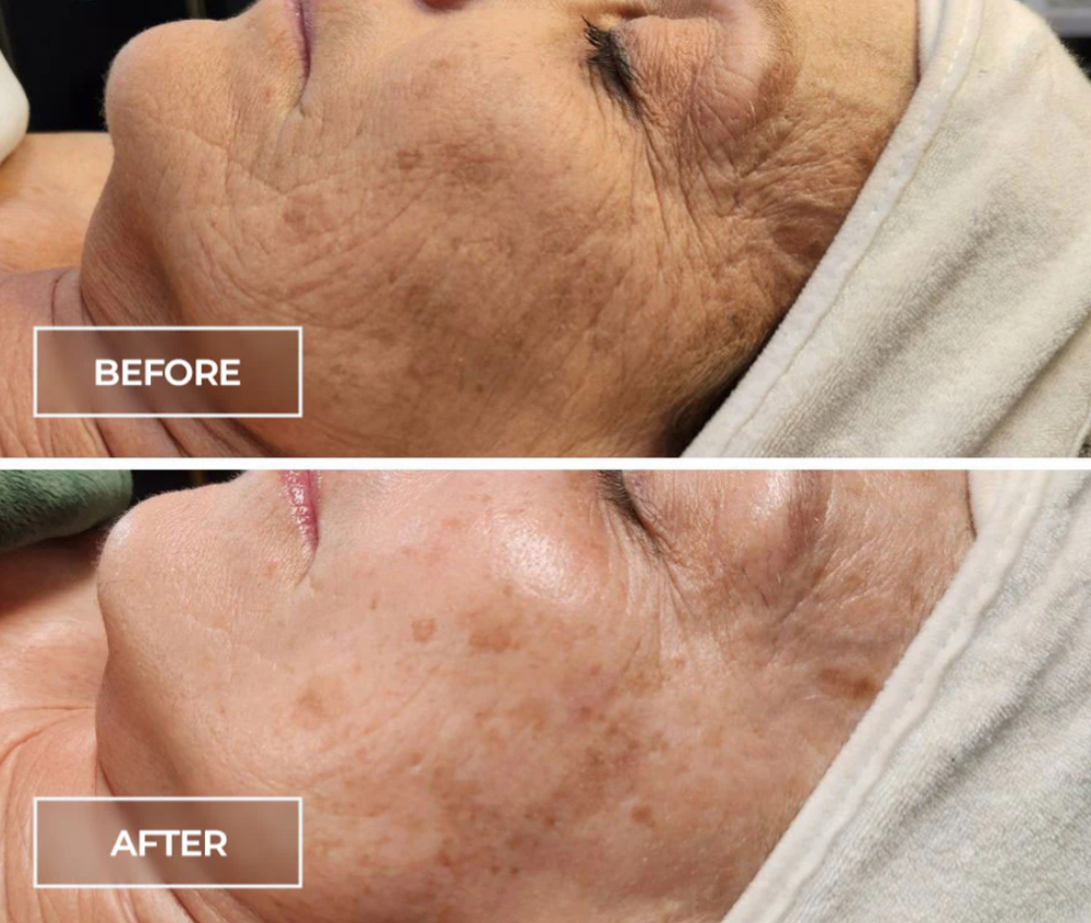 SWiCH™ Dermal Revitalization