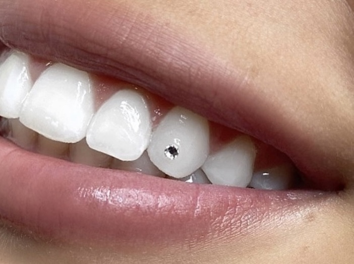 Tooth Gem