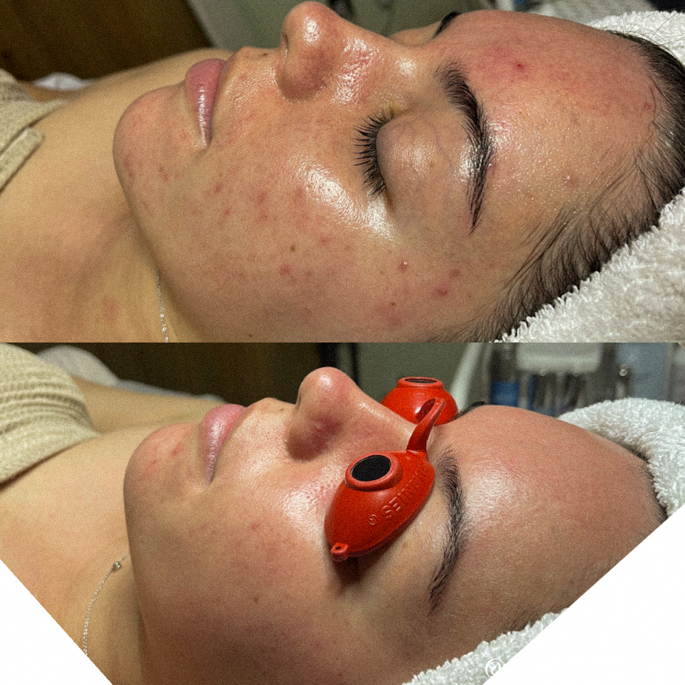 Acne Clearing Facial