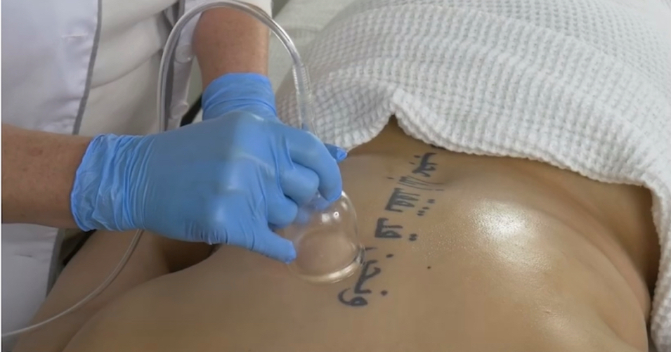 Cupping  🌟OOMNEX Vacuu at ShapedbyNicolabrowsandbody in Brooklyn, NY