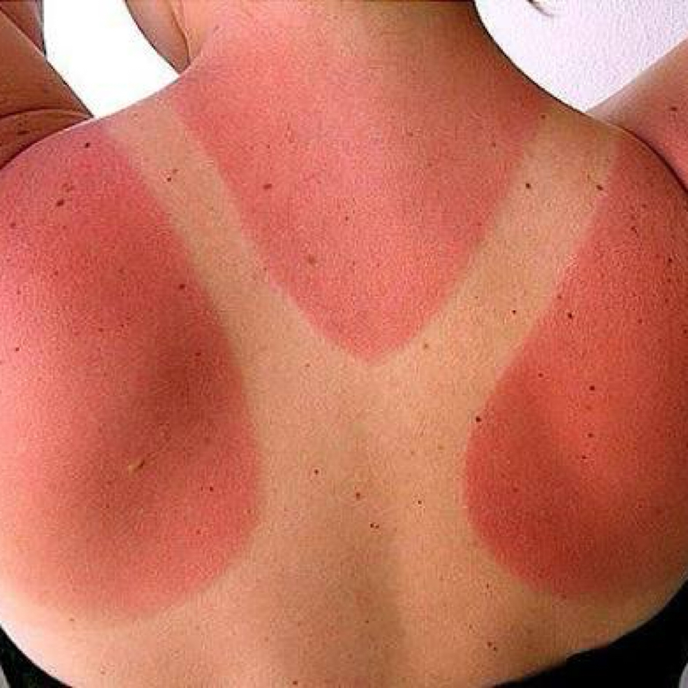 SUN BURN-HEAL at ⚜️ECO•LUX⚜️ in Kahului HI, HI
