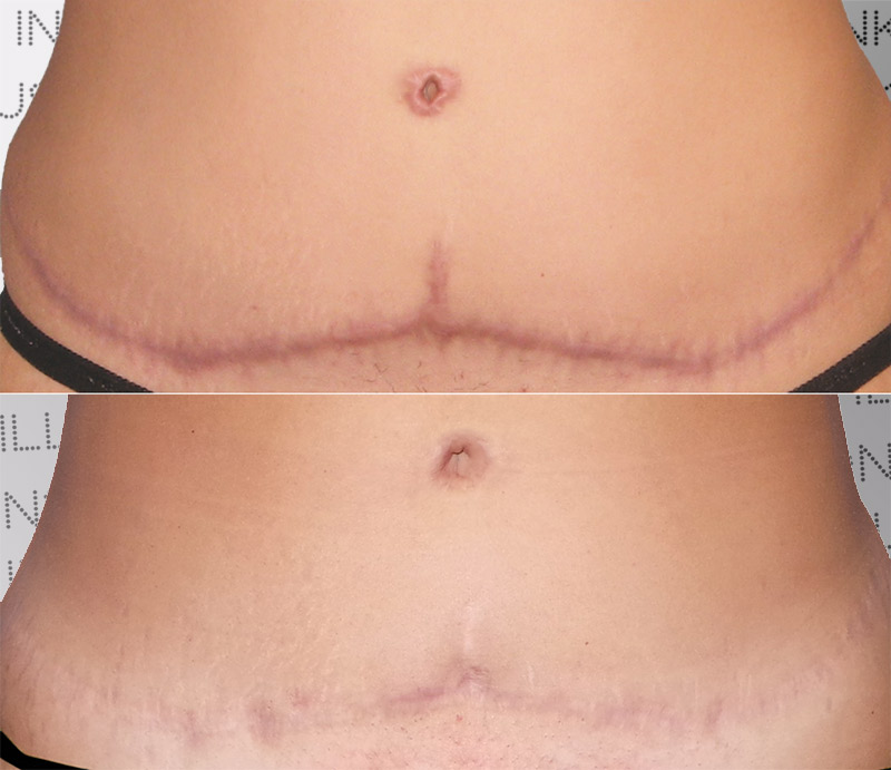 Tummy Tuck Scar Camouflage