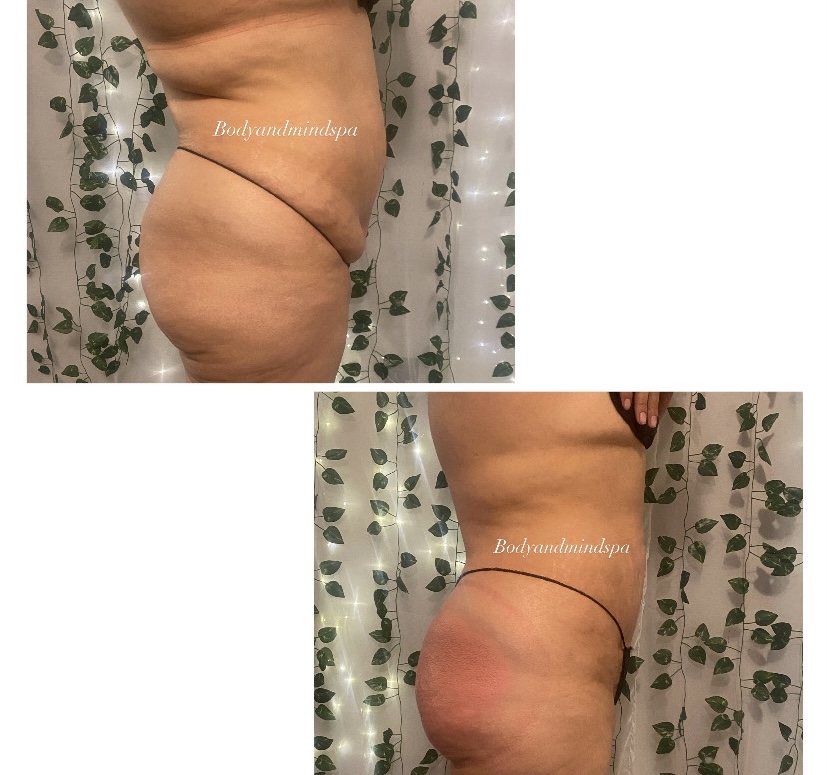 Tummy Combo & Advanced Skin