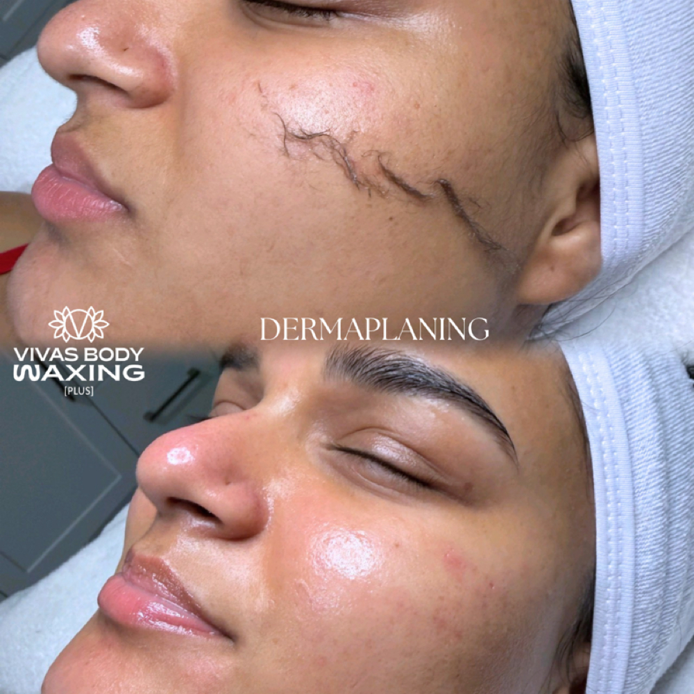 DERMAPLANING ADD-ON at Vivas Body Waxing in Milwaukee, WI