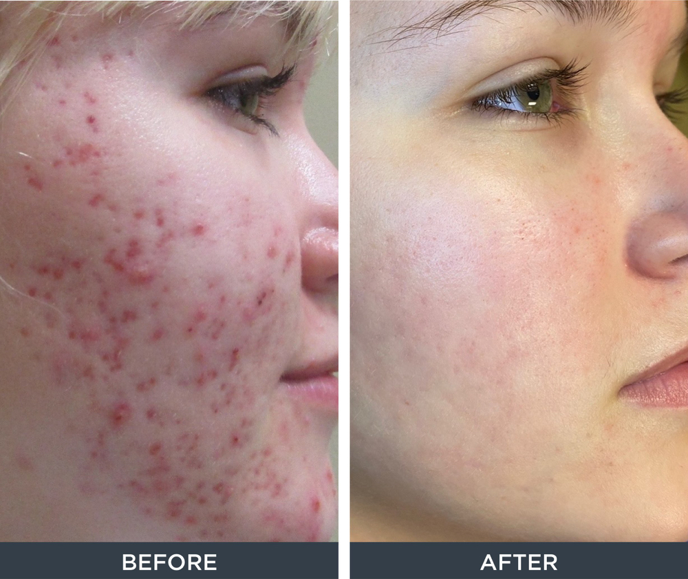 Microneedling