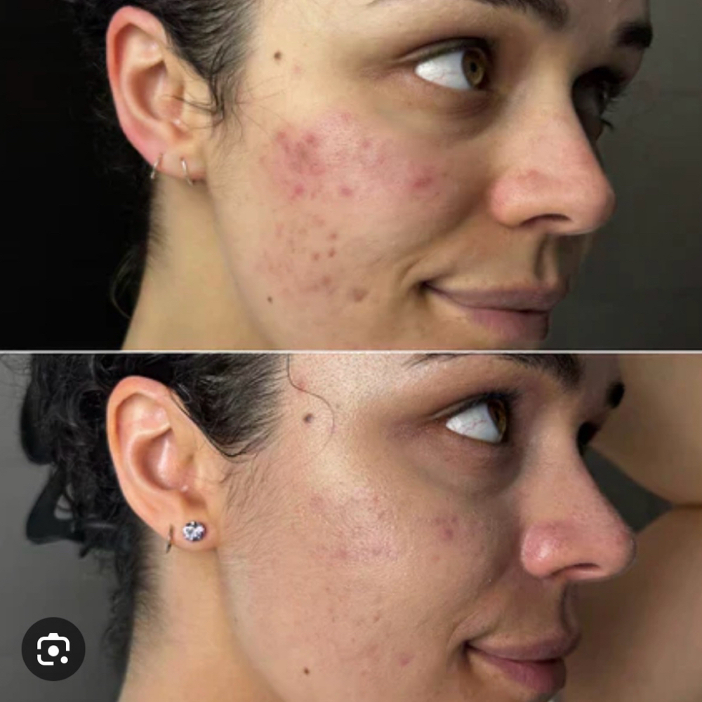 Anti-aging, Acne Red Light Add-on at Therapeutic Massage Solutions in Highland, KS