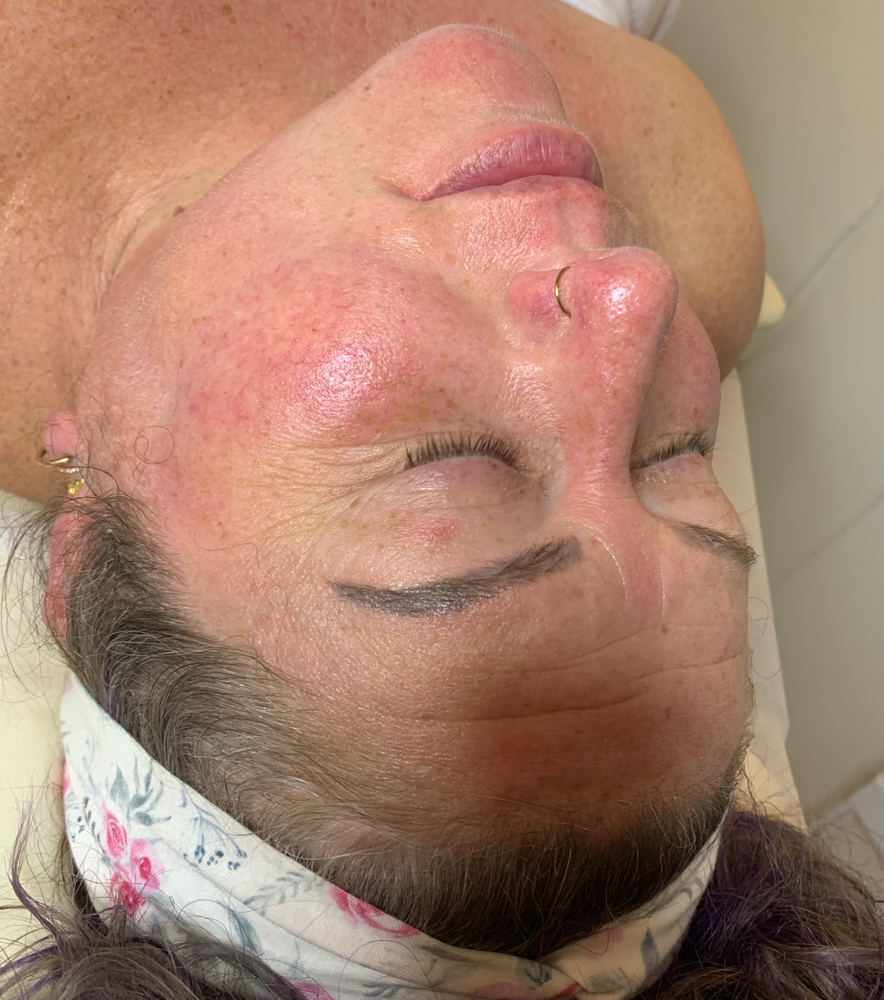 Dry Skin Facial