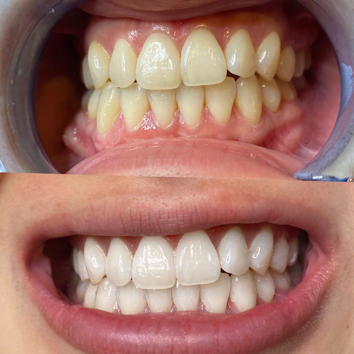 60 Min Deluxe Teeth Whitening