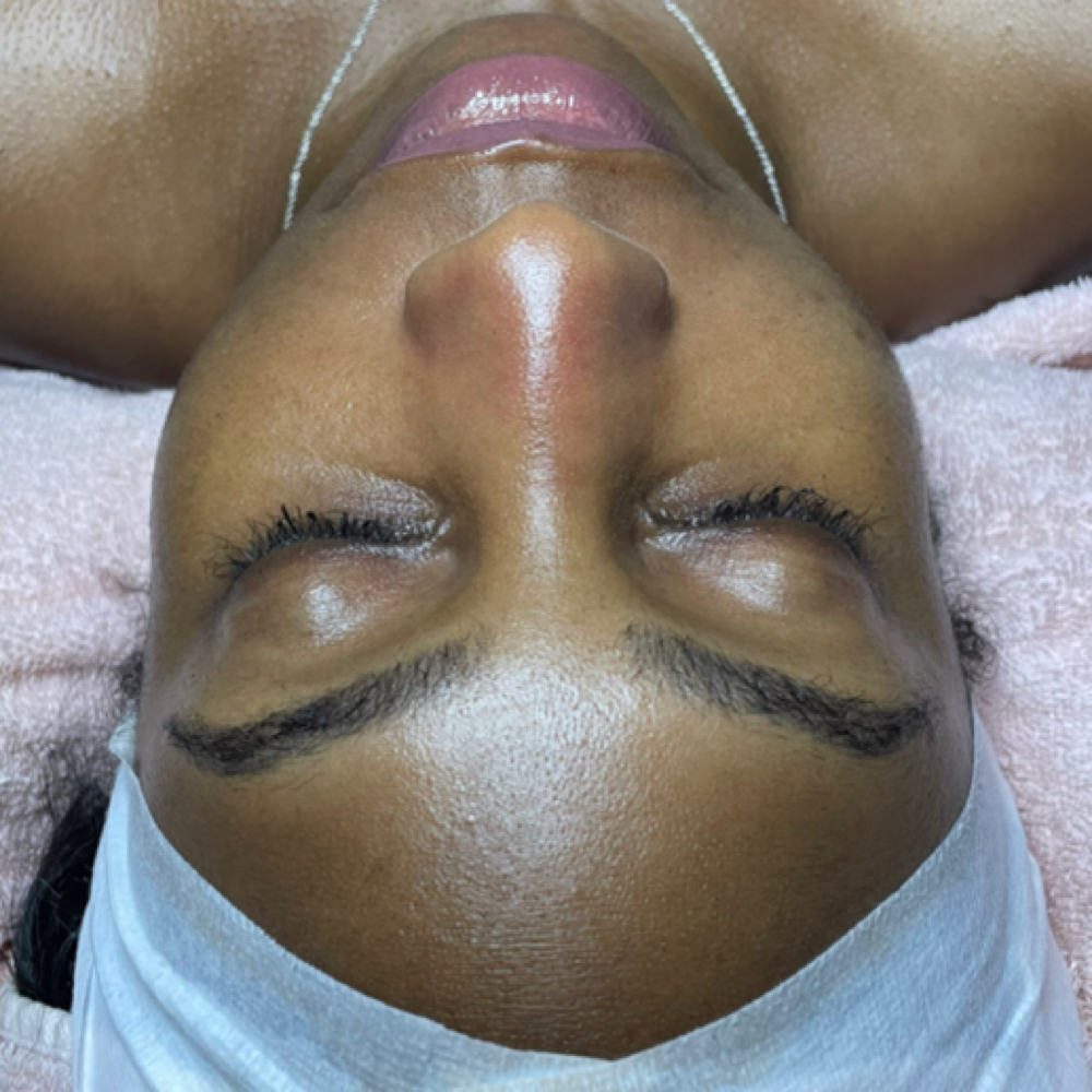 Resurfacing Exfoliation Treatment at Truly Regal in White Plains, NY