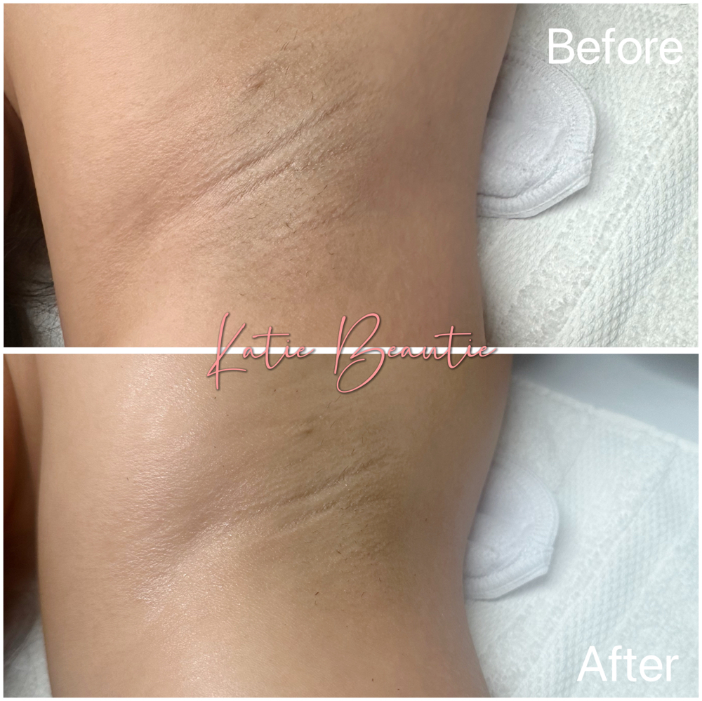 Underarm Brightening