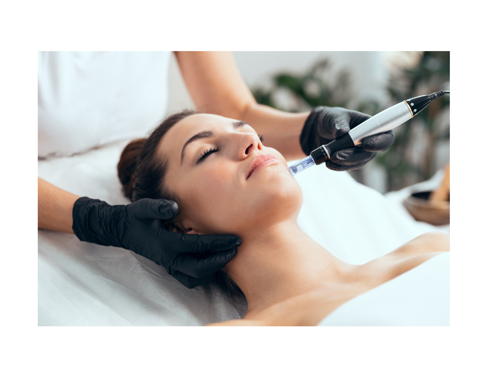 Gold Microneedling Treatment