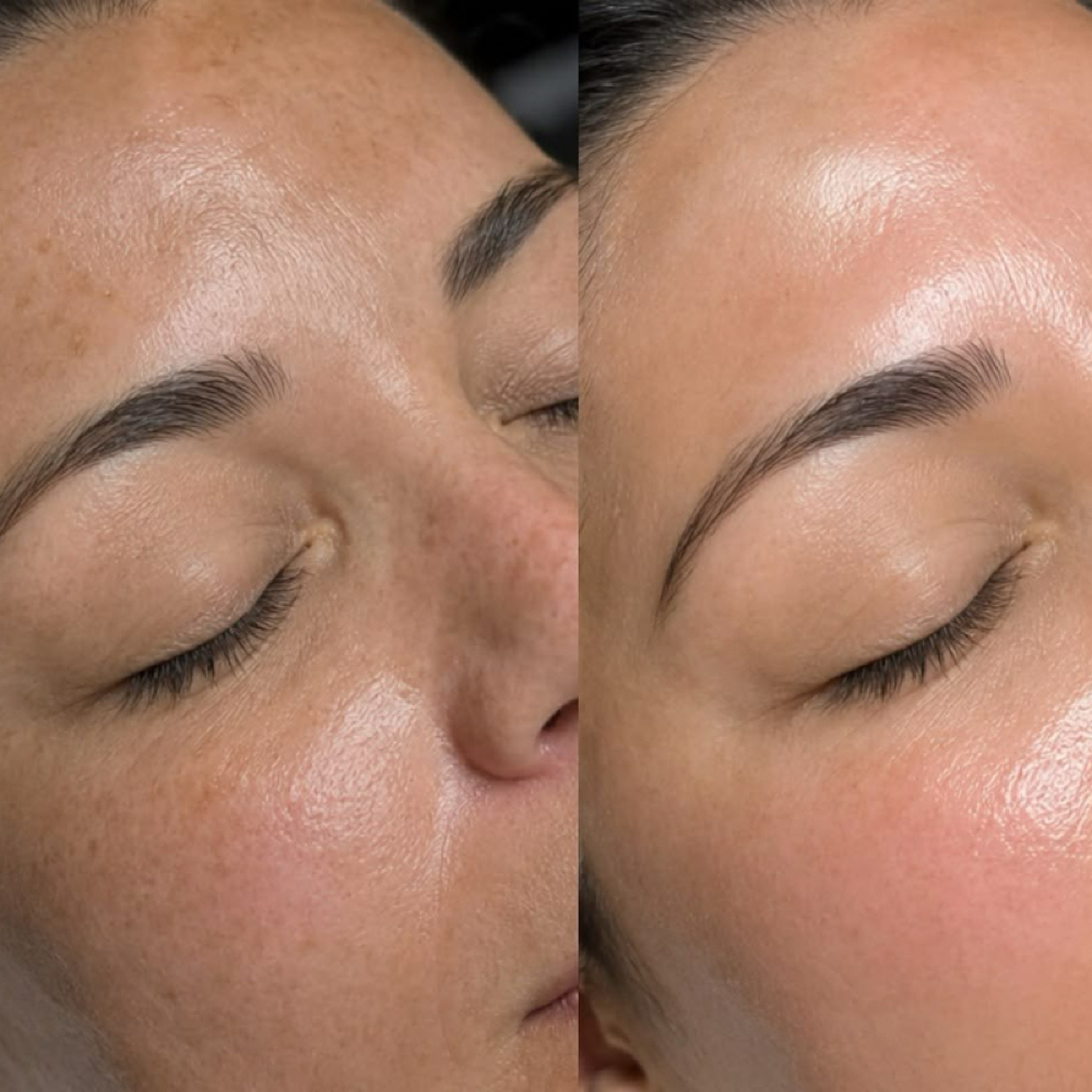 Red Carpet Chemical Peel at Made New Aesthetics in Lone Tree, CO
