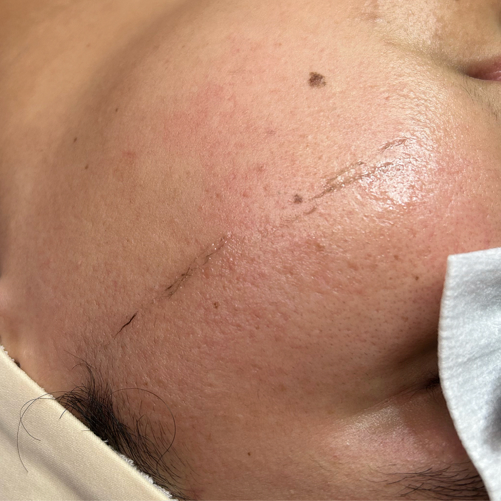 Dermaplane Add On