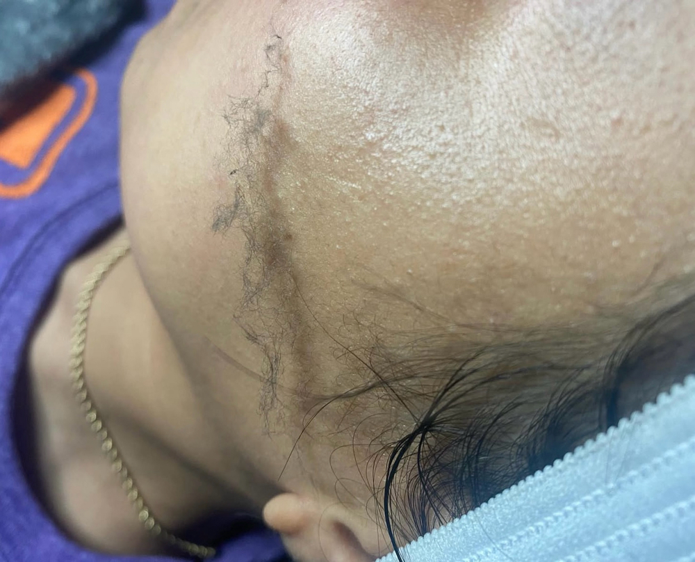 Dermaplane Add On