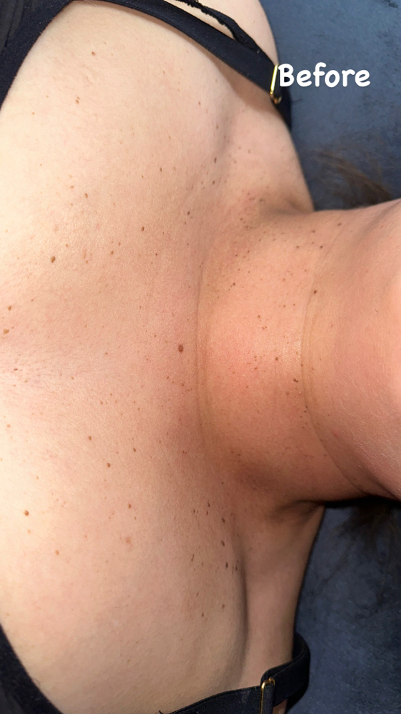 Chest & Neck Skin Tag Removal DEAL