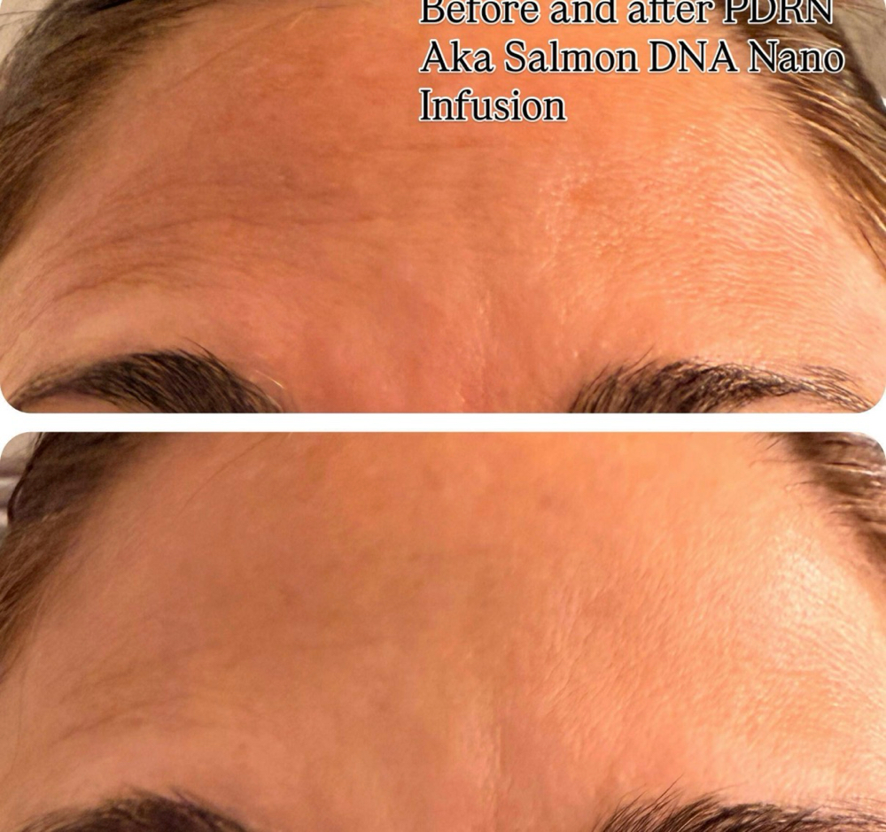 Nano Infusion & Customized Facial