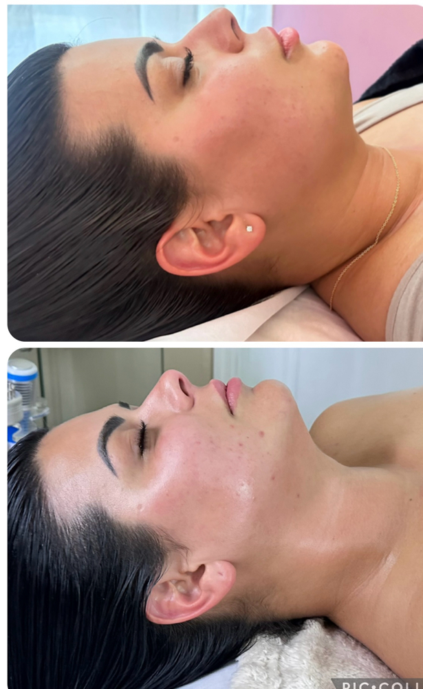 Post-Op Lymphatic Drainage (Chin/Ne at Shelygan’s Lovely Skin Care in Labelle, FL