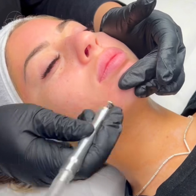 Microdermabrasion