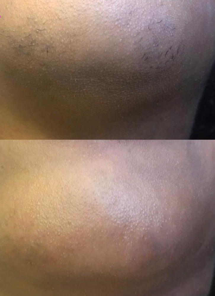 Chin Wax
