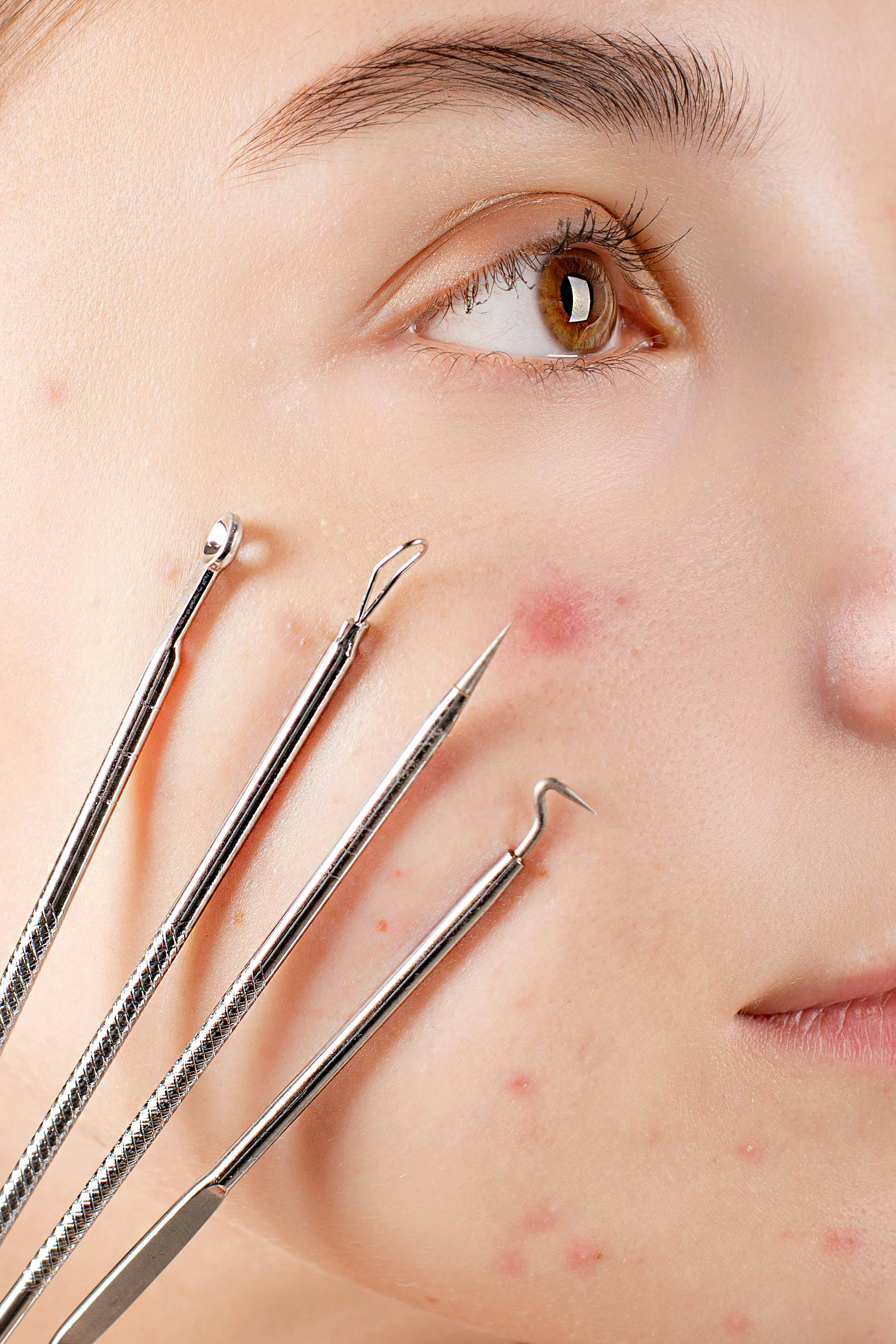 In-Clinic Acne Program Consultation
