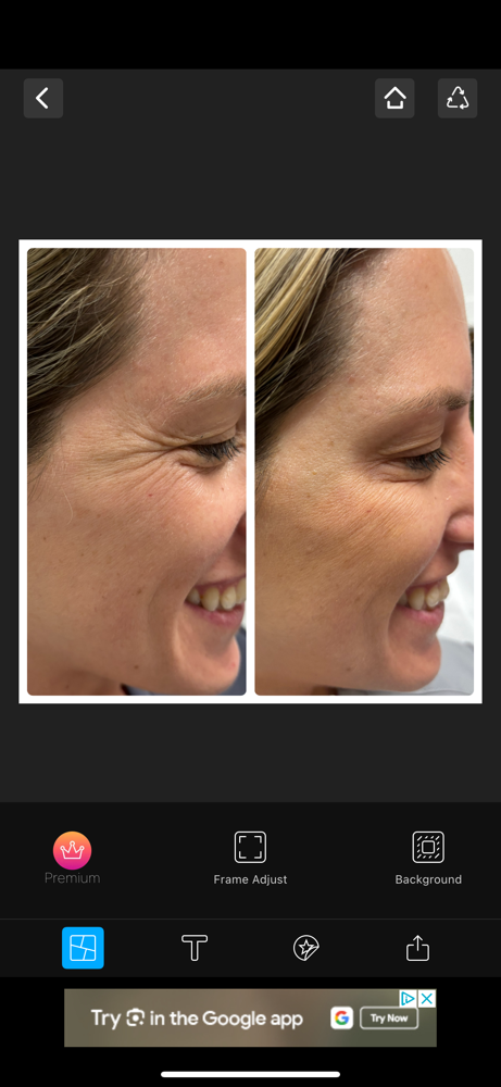 Custom Botox - NEW PATIENT