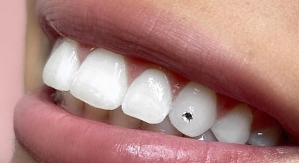Tooth Gem