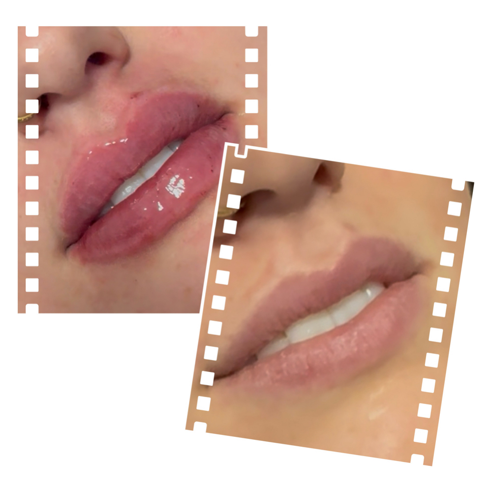 Fillers: Dermal/Lip at DERMÉ Med Spa (formerly LA Lash and Laser Med Spa) in Loveland, CO