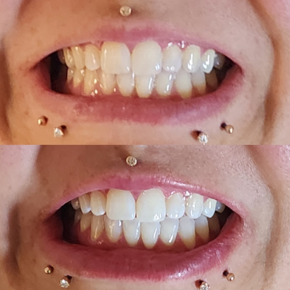 Whitening Standard Session