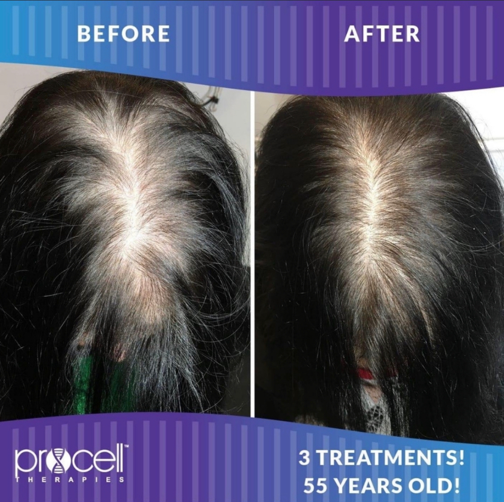 Procell Hair Growth Treatment