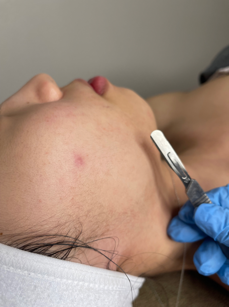 Dermaplane