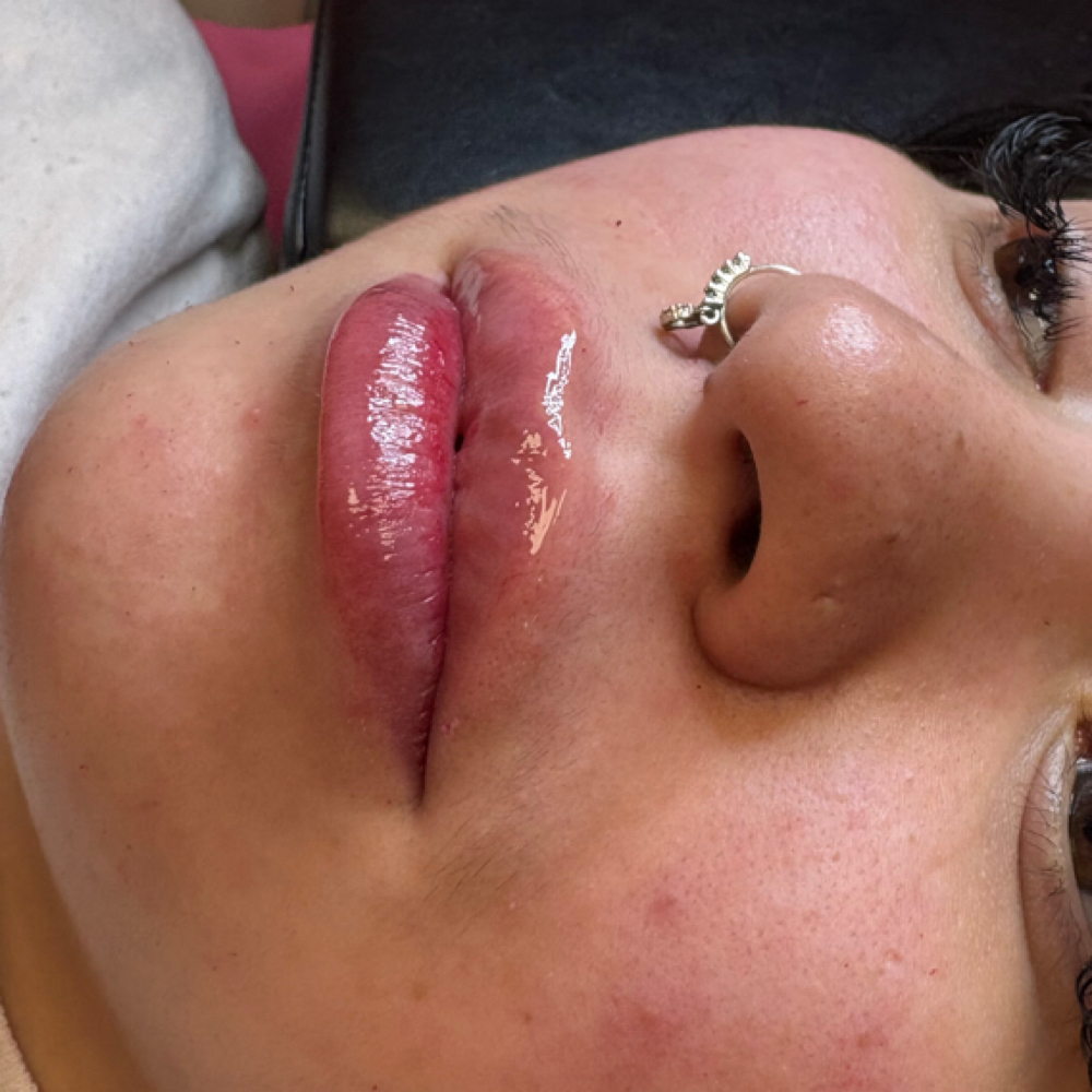 Blush Lip Filler 2ML at Make Me Pretty Aesthetics in Kansas City, MO