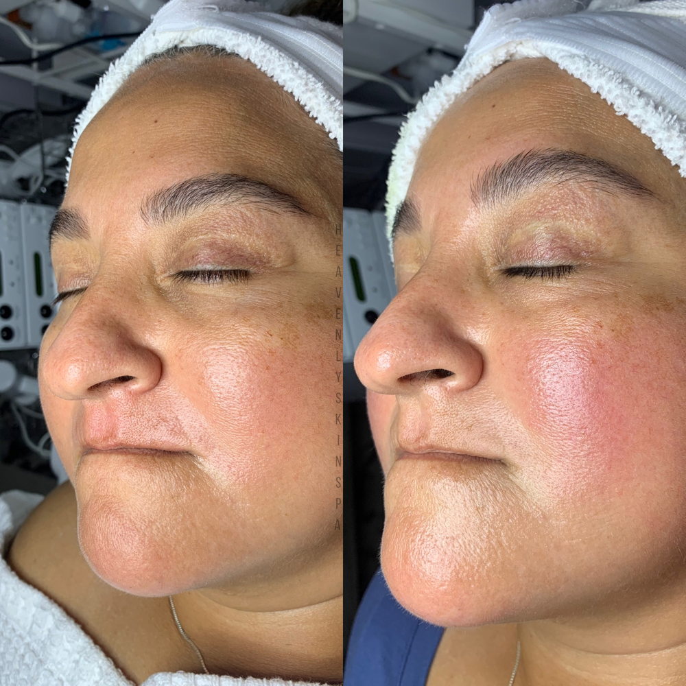 PCA Chemical Peel