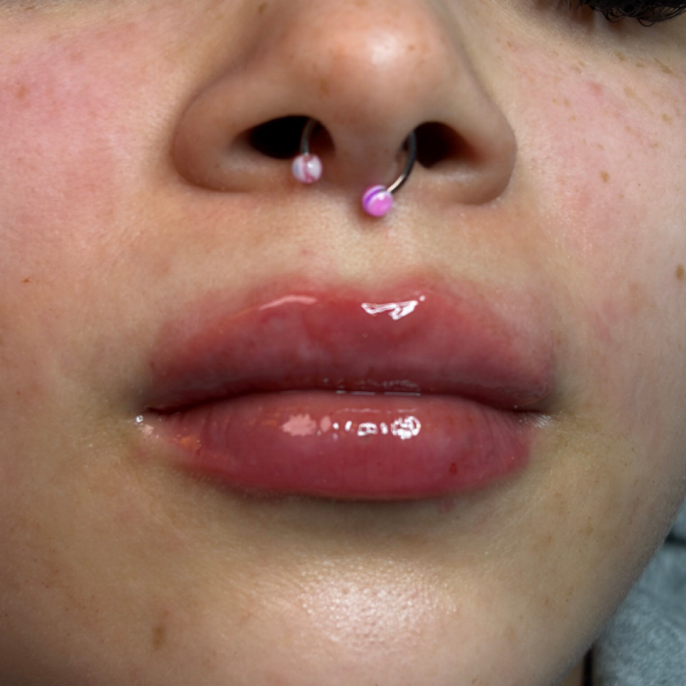 .5ml Micro-needle at Glogetteresthetics in Warwick, RI